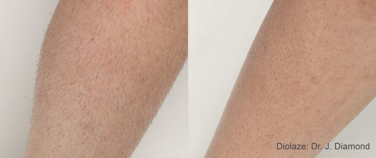 laser hair removal