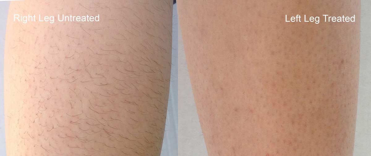 laser hair removal