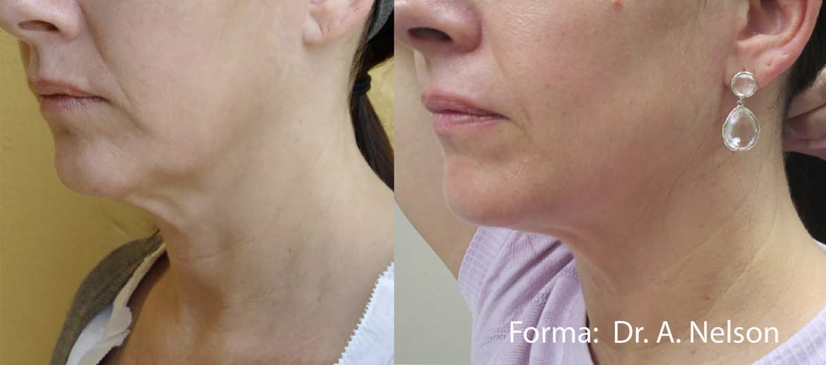 Forma treatment