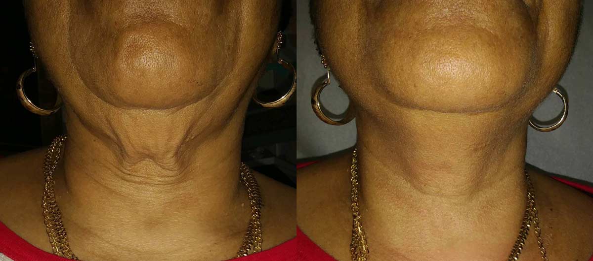 Forma neck treatment