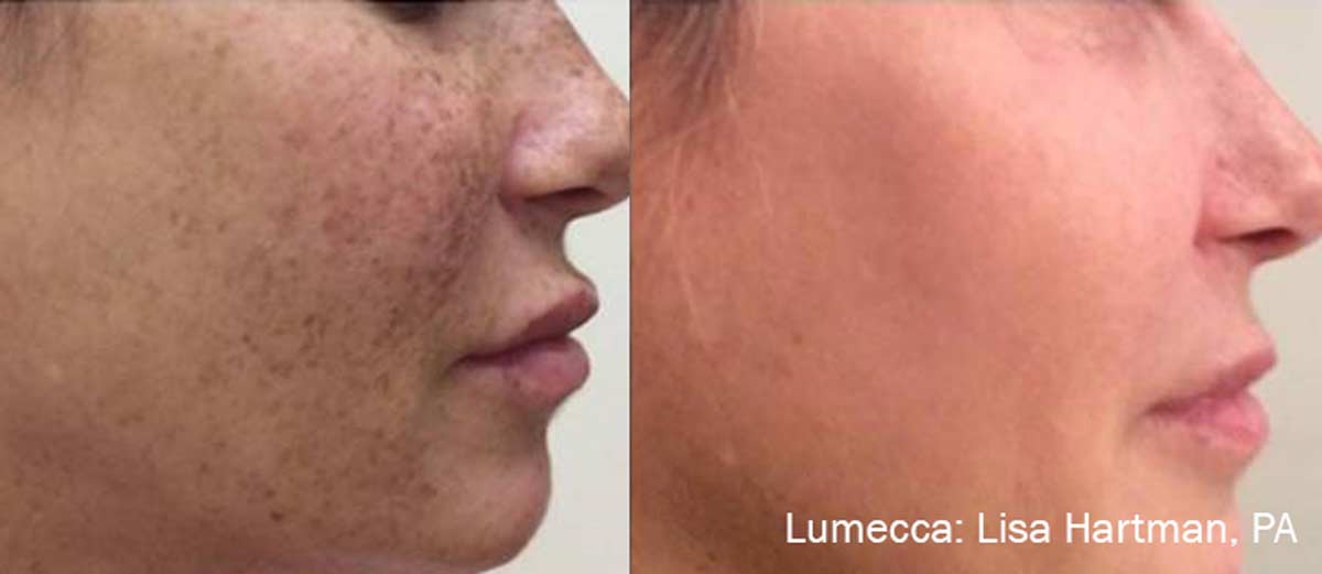 Lumecca treatment