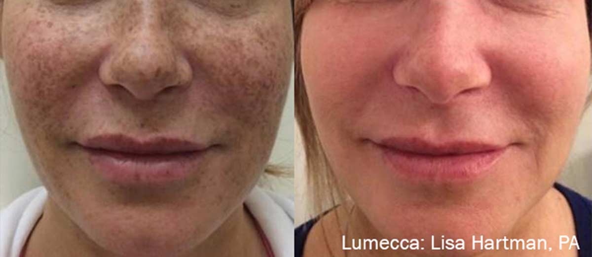 Lumecca treatment